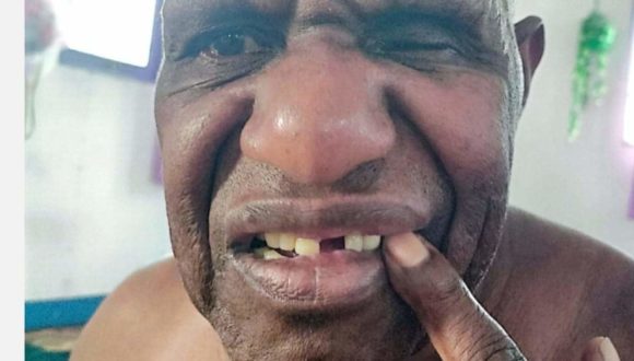 Benny Wenda: West Papua a killing field under Indonesian rule Benny Wenda: West Papua a killing field under Indonesian rule